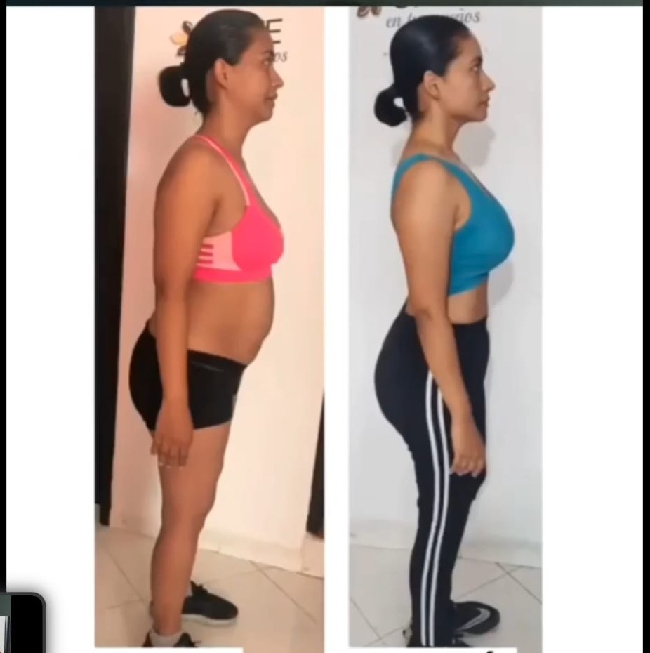 Comparativa antes y después vista de perfil